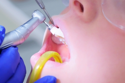 Prophylaxe und Professionelle Zahnreinigung